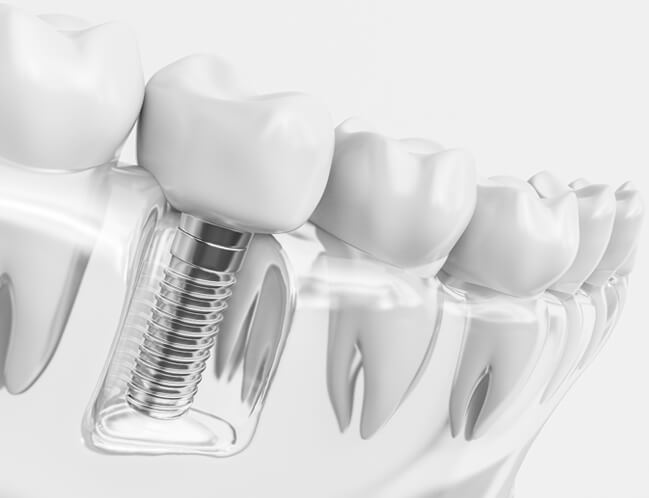 dental implants