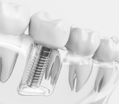 Dental Implants – A Unique Solution For Missing/failing Teeth