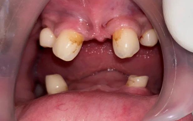 Full Mouth Rehabilitation In A Young Patient With Ectodermal Dysplasia