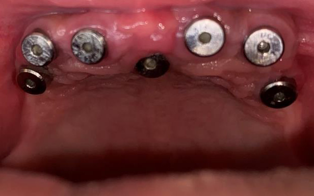 Full Mouth Rehabilitation in a young patient with Ectodermal Dysplasia