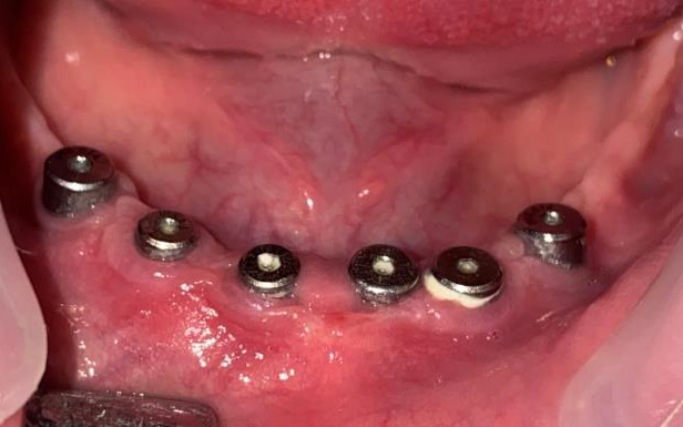 Full Mouth Rehabilitation in a young patient with Ectodermal Dysplasia