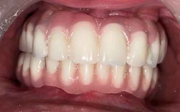 Full Mouth Rehabilitation in a young patient with Ectodermal Dysplasia