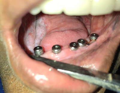 implant dentistry