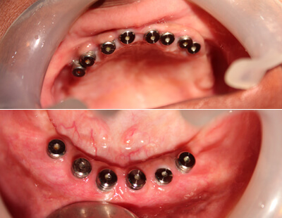 implant dentistry