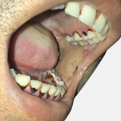 submucous fibrosis