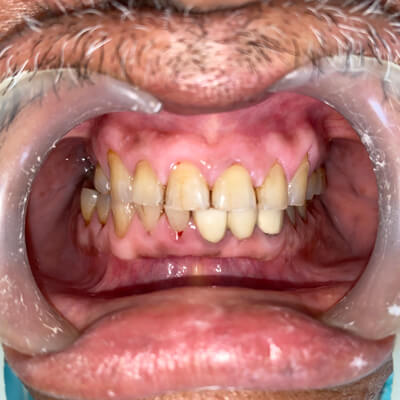 Full Mouth Rehabilitation