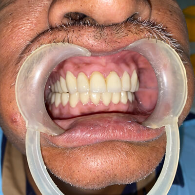 Full Mouth Rehabilitation