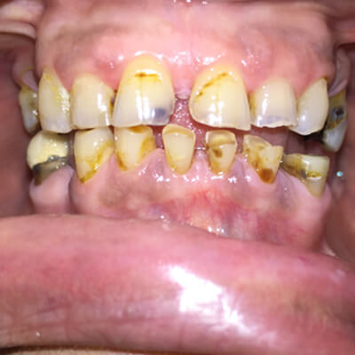 Full Mouth Rehabilitation