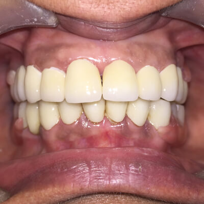 Full Mouth Rehabilitation