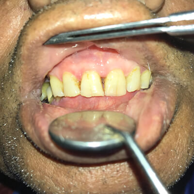 Full Mouth Rehabilitation