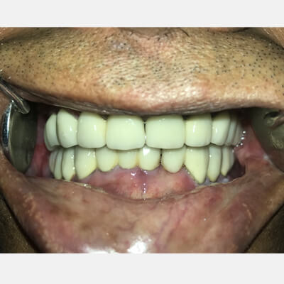 Full Mouth Rehabilitation