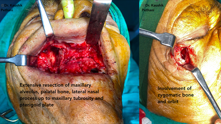 extensive-resection of maxillary alveolus