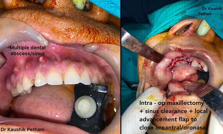 Post Covid-19/ post diabetic Osteomyelities of Jaws