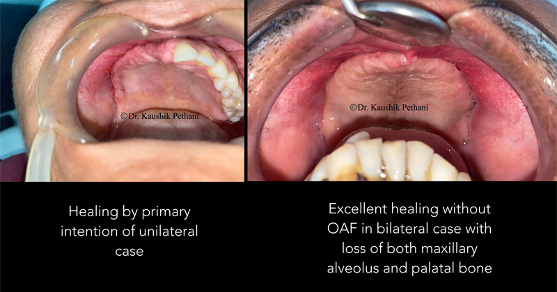 Follow up after Surgery for Mucormycosis